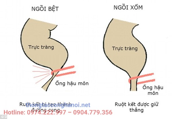 tư thế đi vệ sinh đúng cách